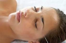 Acupuncture for headaches and migraines