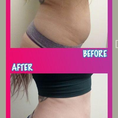 One 5D Laser Lipo session and down 2 1/4 inches immediately with better results expected to follow!