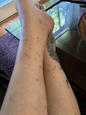 Bug bites