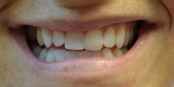 Look what 15 minutes and a filling 
can do for your smile!