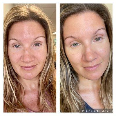 Chemical peel before and after