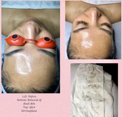 The picture says it all!! Healthier, glowing skin immediately after her dermaplane treatment!