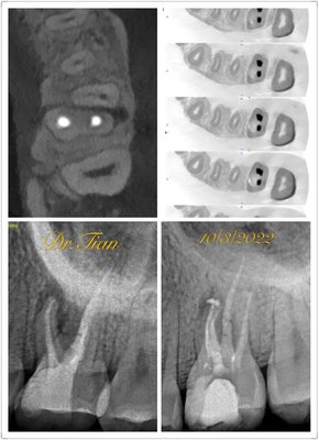 Retreat Molar RCT under CBCT X-Ray Scan and Microscope