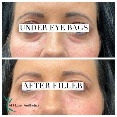 Fillers for under eye area