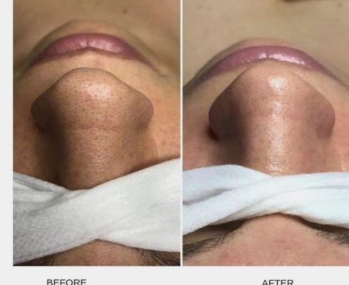 Before and after receiving a Hydrafacial, pores are cleansed hydrated.