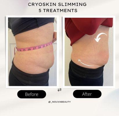 Cryoskin slimming treatments (5 treatments)
Great results and no downtime or pain