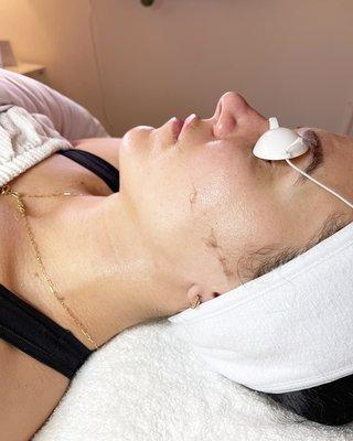 Dermaplaning