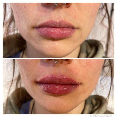 Lip filler