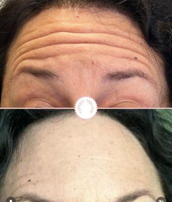 Only 5 days post neurotxoin
 
 Our neurotoxins offer a youthful rejuvenated appearance by smoothing unwanted