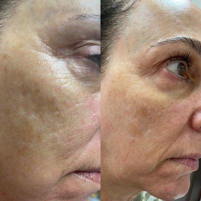 Hyperpigmentation treatment