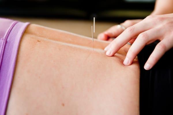 Acupuncture treatment.