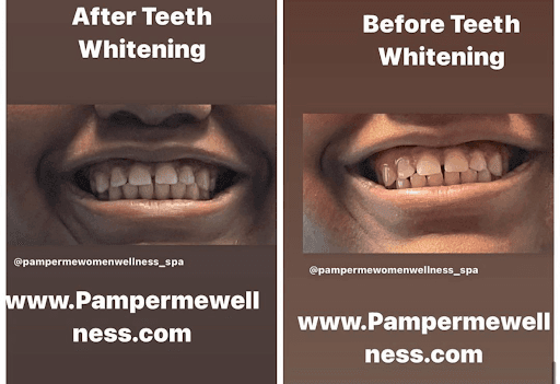 Teeth whitening