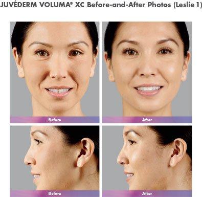 Juvederm / Skin Tightening in Washington, DC 20006