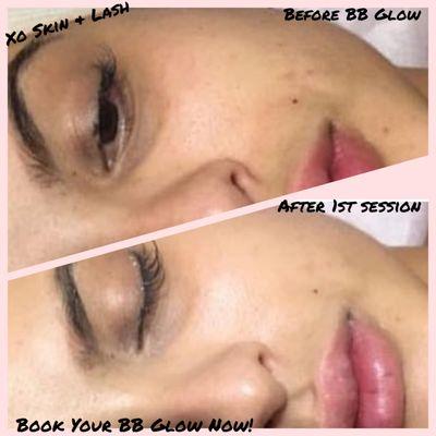 Wake up and go with BB Glow!  Our treatment that helps with fine lines, skin discolorations, acne scars, age spots, & much more.