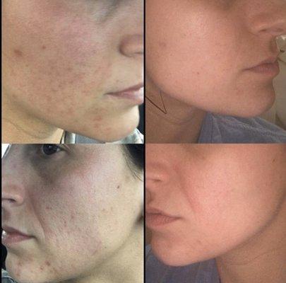 Acne facial