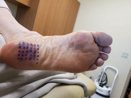 This is my foot after surgery For planter fascititis to change the dressing.