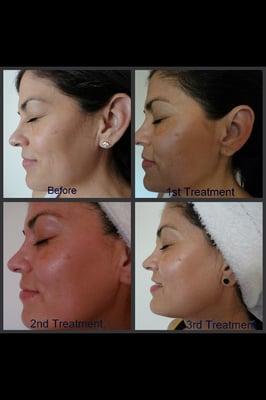 3-Treatments of 90 min-Microcurrent Facial Toning Treatments