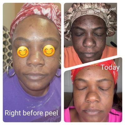 My client's chemical peel process