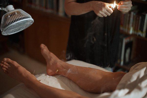 Moxibustion during an acupuncture treatment at Peony.