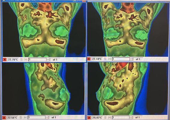 Breast Thermography Scan