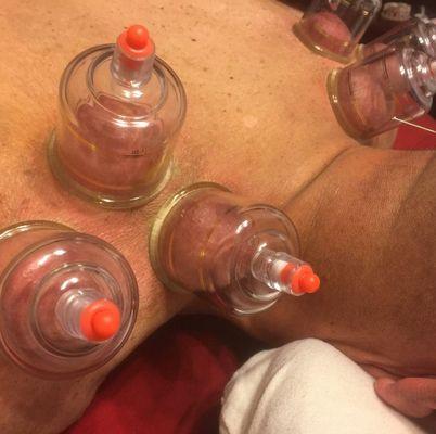 Enjoy acupuncture and cupping for your next appointment here at Moroso Medical Center.