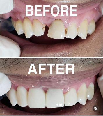 Another happy client with a new smile in just 30 minutes!