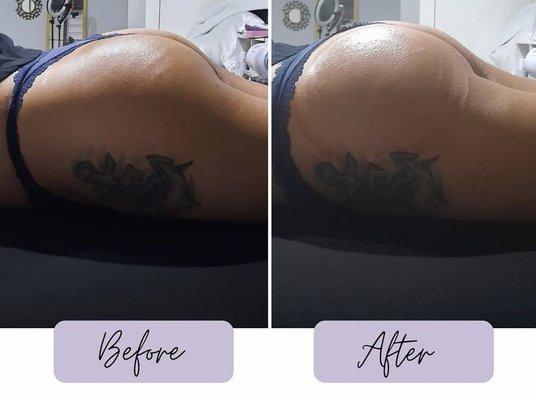 Nonevasive , nonsurgical & no downtime ! This is a before and after 1st BBL session