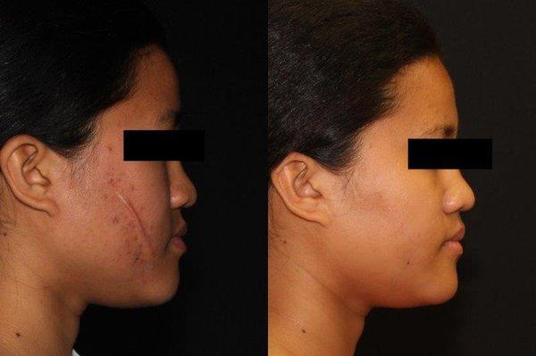 25 year old before and six months after excision and repair of facial scar.