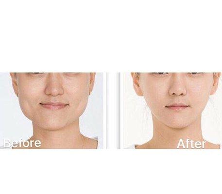 Botox Jaw Slimming. Non-surgical.