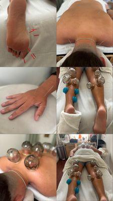 Acupuncture and cupping therapy.