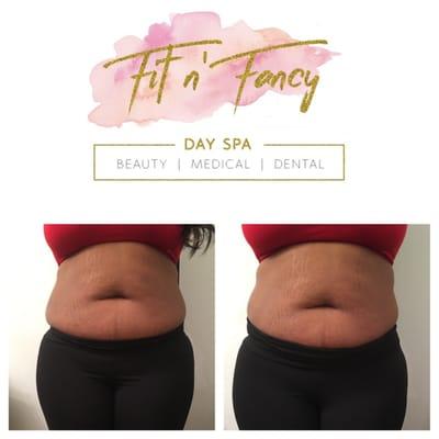 Loose 2"+ inches in as little as 20 minutes from a Strawberry Laser Lipo treatment