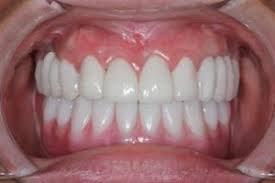 Semi-fixed Implant dentures