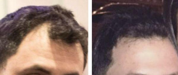 Before and after 3 PRP hair restoration treatments!