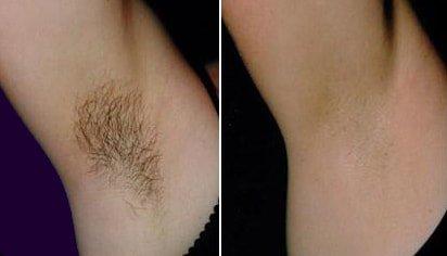 Remove Underarm Hair