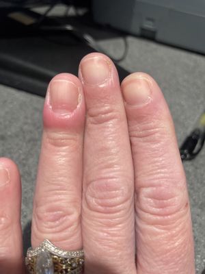 Infected ring finger and non existent cuticle that is NOT growing back.