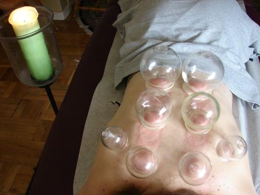 Cupping Therapy