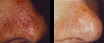 Spider vein removal for legs and face.  Instant results, no down time using the latest technology thanks to VeinGogh.