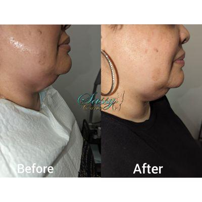 Chin lift with non-invasive laser lipo treatment