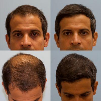 Carolina Hair Surgery