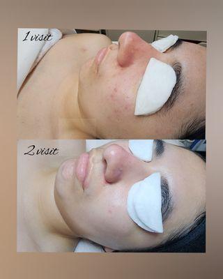 Having a Facial can help you clear active acné.