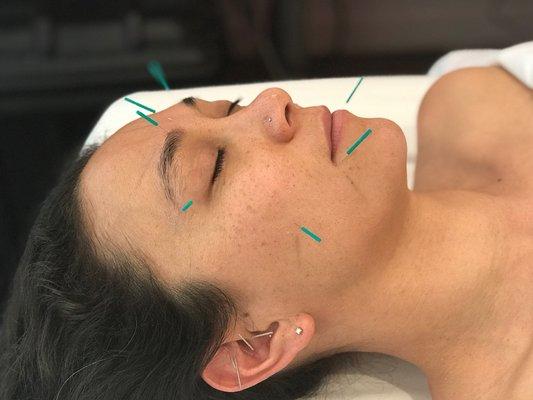 Believe it or not, this patient fell asleep durning her acupuncture treatment.