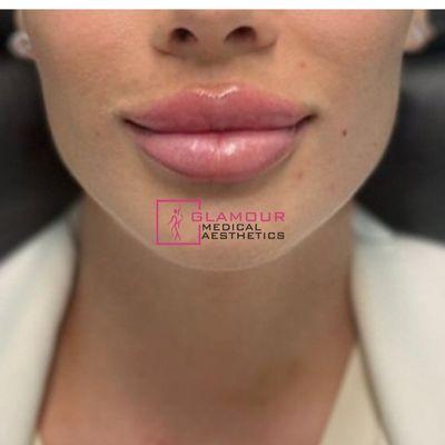 Lip Fillers