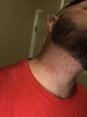 This is my neck within the hour of the shave.