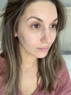 After one year of treatments and sticking to the recommended skin care routine: No makeup