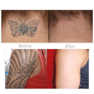 Laser tattoo removal