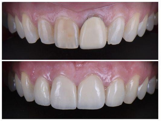 3 Veneers and 1 old crown replaced