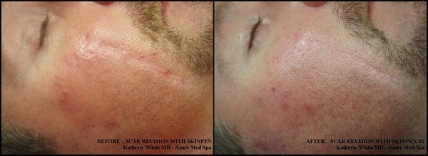 Scar revision with SkinPen