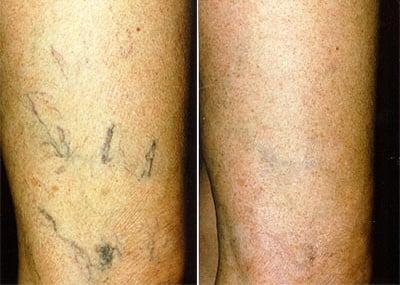 Sclerotherapy Vein Treatments