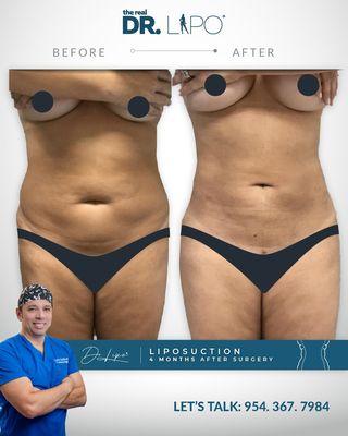 Excelent results after liposuction!!!