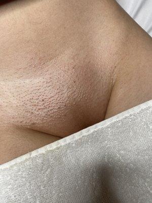 Brazilian sugaring